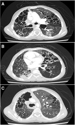 Lymphocytic interstitial non-HIV-related pneumonia in pediatrics: a case report